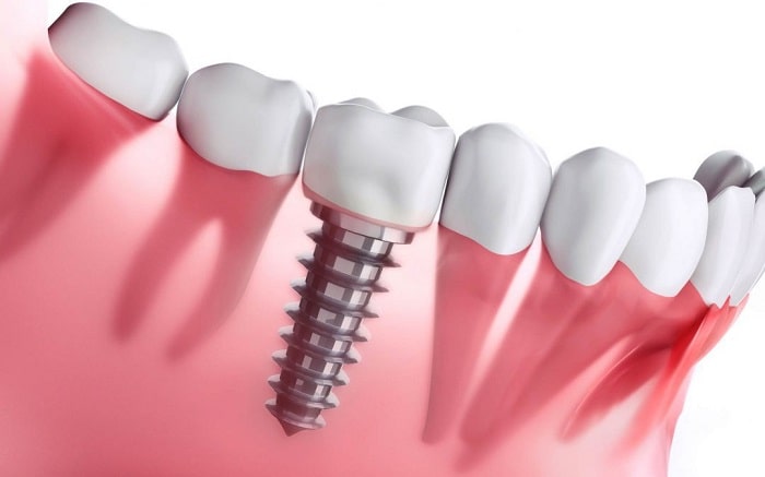 Exploring the Cutting-Edge Advances in Dental Implant Treatment